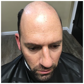 Men's Hair Replacement - Before
