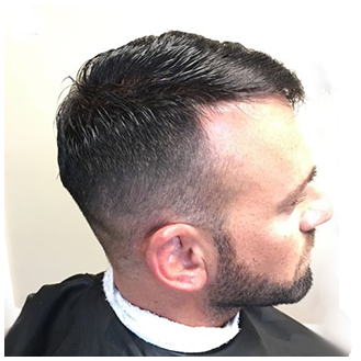 Men's Hair Replacement - After